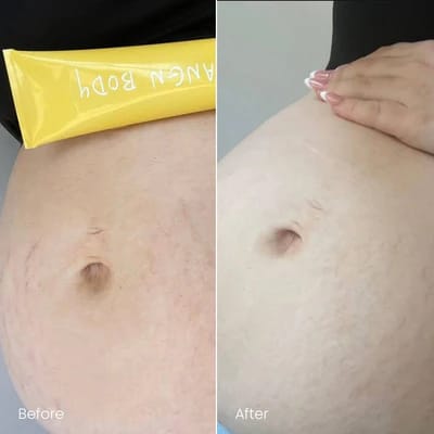 STRETCH MARKS · BELLY, before and after
