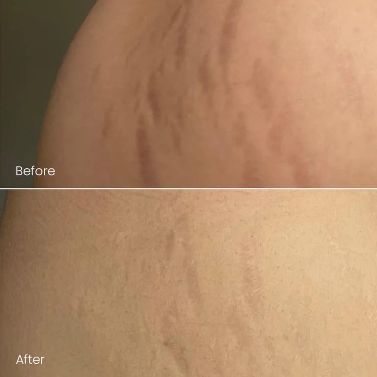 STRETCH MARKS, before and after