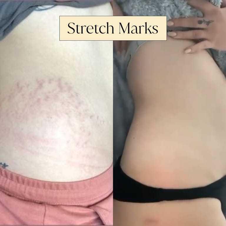 STRETCH MARKS · MIDSECTION, before and after